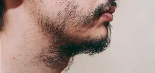 Barba falhada