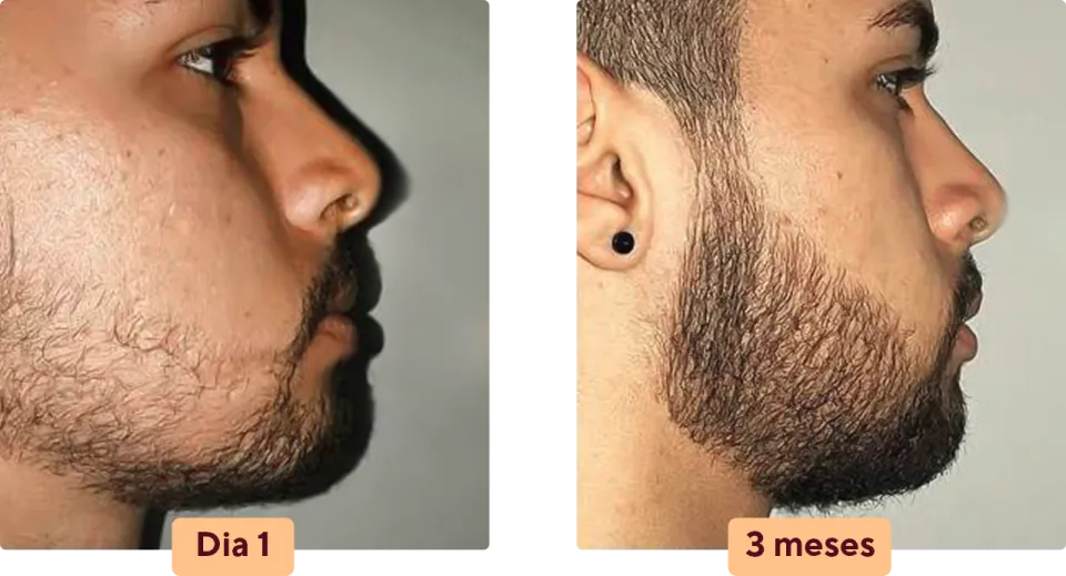 Antes e depois barba