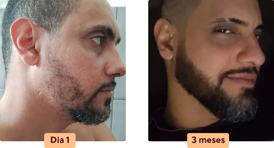 Antes e depois barba