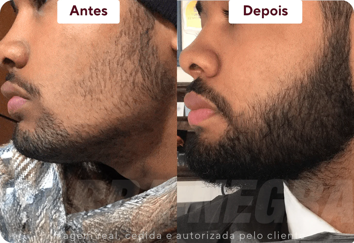 Resultado barba